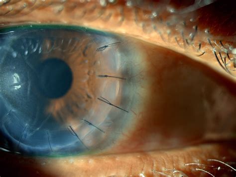 Corneal Graft Success Over 30 Years