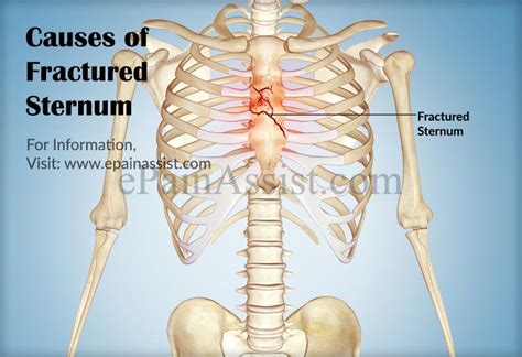 Fractured Sternum|Causes|Symptoms|Treatment|Exercise|Prognosis|Signs