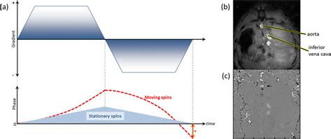Phase-contrast MRI-(a) schematic diagram of sequence and (b, c) example... | Download Scientific ...