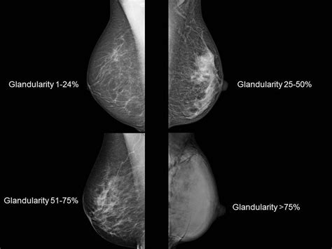 What Is Fibroglandular Density