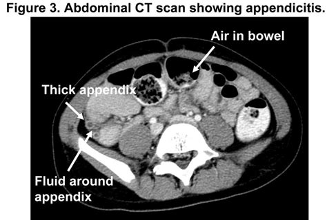 HEALTH FROM TRUSTED SOURCES: Appendicitis