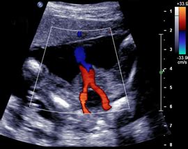 Umbilical Artery Ultrasound