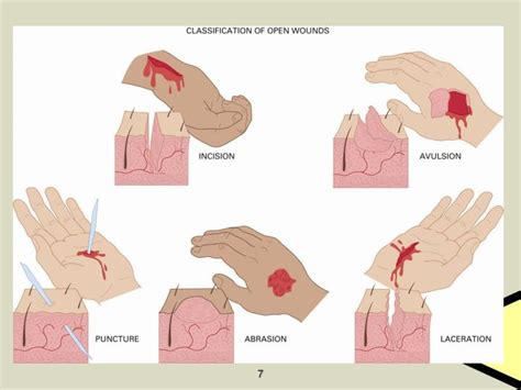 7 Types Of Wounds | My XXX Hot Girl