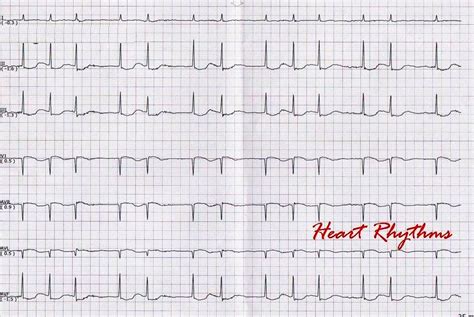 ECG Rhythms: Atrial fibrillation with entrance block and junctional ...