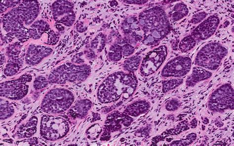 Pathology Outlines - Adenoid cystic carcinoma