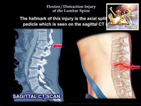 Flexion Distraction Injury Of The lumbar Spine - Everything You Need To Know - Dr. Nabil ...