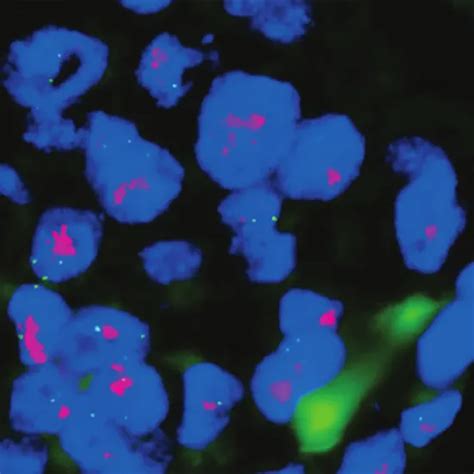 FISH, Prenatal Aneuploidy Detection-Amnio (5 Probes - Trisomy 21,18,13,X,Y) Test | GDIC