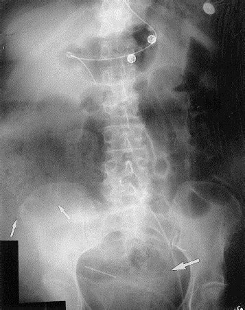 Fecal impaction: a cause of isolated small bowel dilatation on abdominal radiographs - European ...