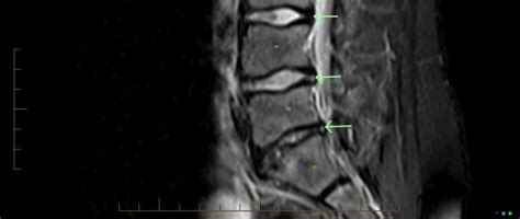 MRI, sagittal STIR midline image. Annular tears are seen as posterior ...