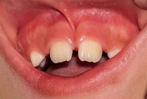 Frenectomy | Studio Dentaire