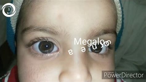 Megalocornea a very rare and interesting case - YouTube