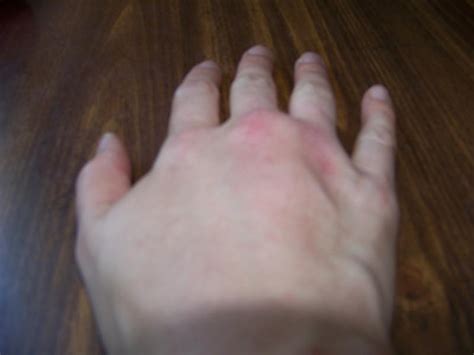 Flying Ants bite - allergic reaction ? (Orono, Lincoln: insurance, home, allergy) - Maine (ME ...