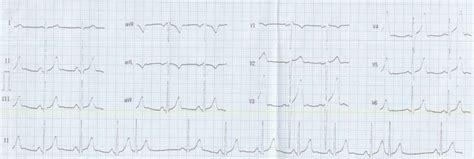 Supraventricular ectopics – All About Cardiovascular System and Disorders