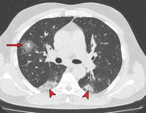 Hrct Scan