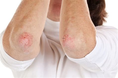 Menopause & Eczema | Livestrong.com