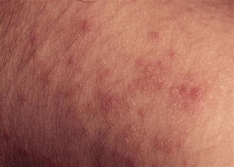 How do I Recognize a Rubella Rash? (with pictures)