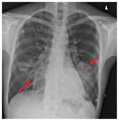 Exogenous lipoid pneumonia associated with oil-based oral and nasal ...