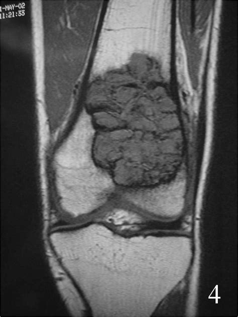 Giant Cell Tumor Mri