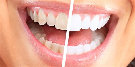 Professional Teeth Whitening in Alexandria | King Centre Dental | Dentist VA 22315