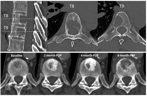 Cancers | Free Full-Text | Fracture Risk Evaluation of Bone Metastases: A Burning Issue