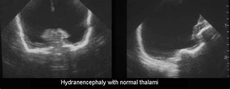 Hydranencephaly And Porencephaly