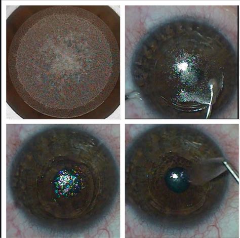 SMILE, LASIK Have Similar Efficacy for Astigmatism Correction