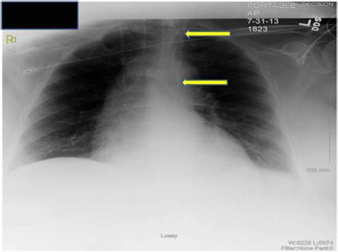 Chest Radiography. Chest-X ray showing the Quinton-Mahurkar catheter ...