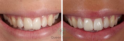 Inman Aligner Treatment Bristol - Queen Square Dental Clinic