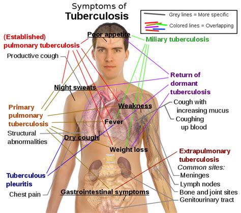 Tuberculosis Symptoms Diagram - Free Health & Medical Pictures ...