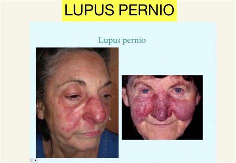 Lupus Pernio - MEDizzy