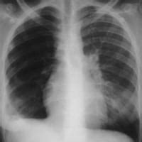 CXR eponyms in pulmonary embolism • LITFL • Medical Eponym Library