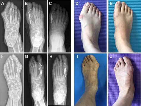 Frontiers | First metatarsal single-screw minimally invasive chevron ...