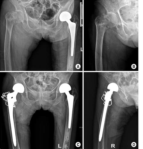 Table 1 from Bipolar Hemiarthroplasty Using Calcar Replacement Stem for Hip Fractures in the ...