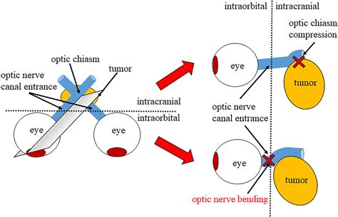 Schema from the eyeball to the optic chiasm in a patient with sellar... | Download Scientific ...