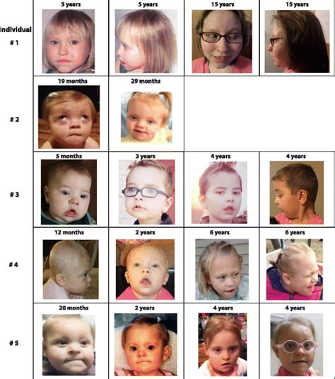 Photographs of patients displaying common facial features. Shared... | Download Scientific Diagram