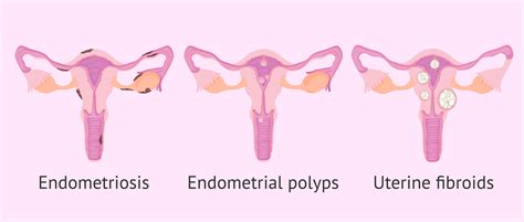 Pathologies affecting the endometrium