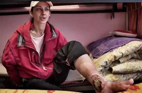 Flesh-eating drug Krokodil has hit the UK - Pattaya One News