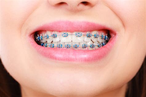 Metal Stainless Steel Braces - Bank Cottage Dental | Dentist in Thornbury, Bristol