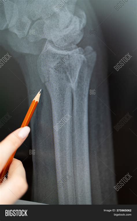 X-ray Broken Arm Image & Photo (Free Trial) | Bigstock