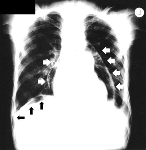 Pneumopericardium in resolution phase after removing a pericardial... | Download Scientific Diagram