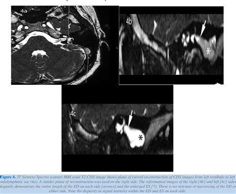 Figure 1 from CT and MRI Evaluation of Bilateral Enlarged Vestibular Aqueduct Syndrome with ...