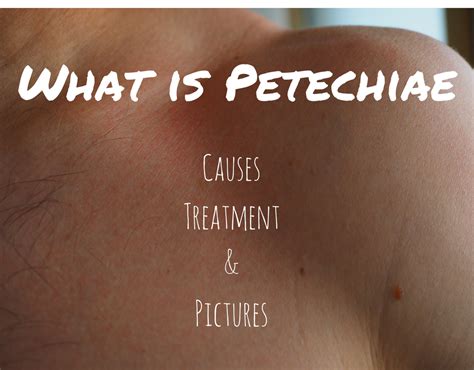 What is Petechial hemorrhage | Petechiae Rashes , With Pictures