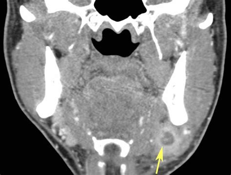 RiT radiology: Submandibular Sialadenitis with Abscess
