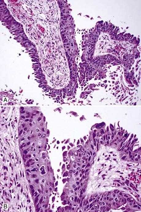 Papilloma Papilloma Squamous Cell Papillomatosis