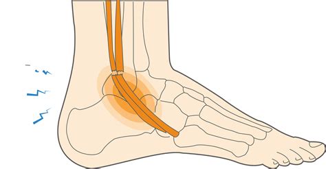 Peroneal Tendonitis Pain On Top Of Foot Outlet | emergencydentistry.com