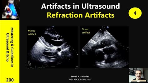 Artifacts in Ultrasound 4: Refraction Artifact - YouTube