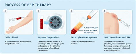 PRP Injections | St George SportsMed Orthopaedics and Sports Medicine