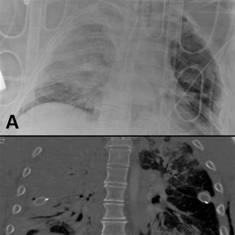 Displaced transverse sternal fracture in coronal CT scan (A) and ...