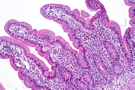 Coeliac Disease | Symptoms, Signs, Management | Geeky Medics