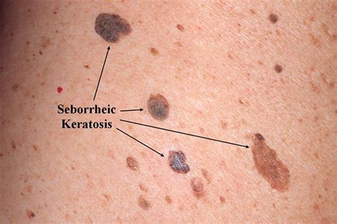 Best Seborrhoeic Keratosis Removal Treatment Clinic in North London